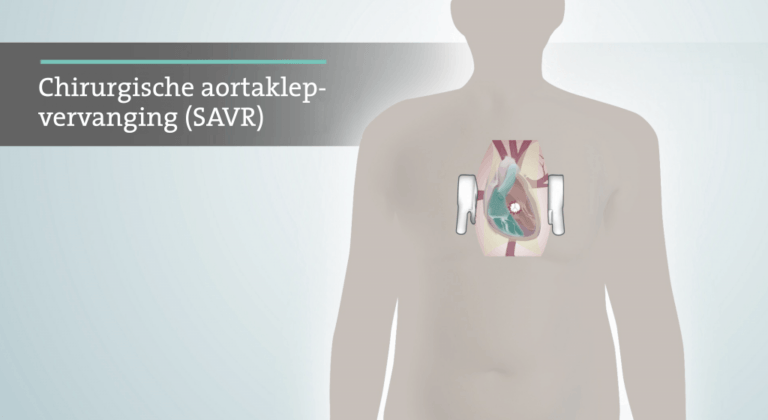 Heart valve placement