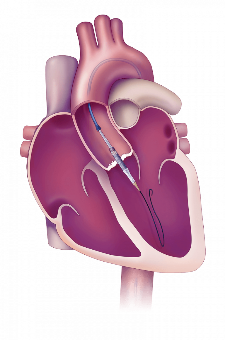 Heart valve placement