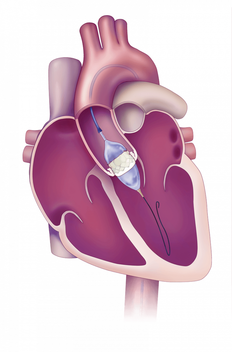 Heart valve placement