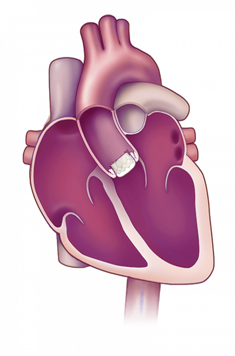 Heart valve placement